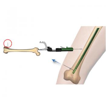 芯鉆髓內(nèi)釘
